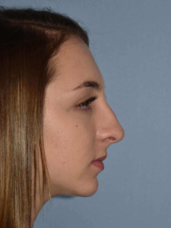 Rhinoplasty Before & After Gallery - Patient 205628 - Image 1