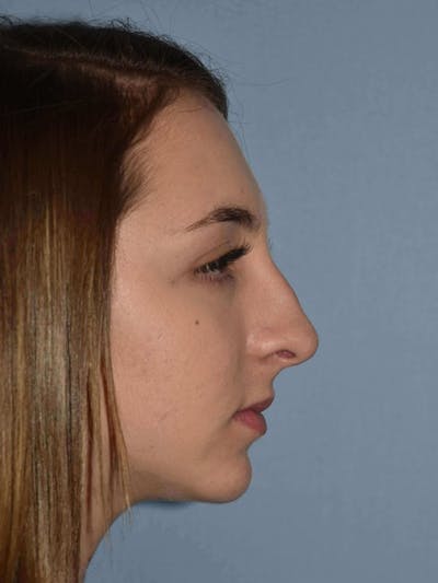Rhinoplasty Before & After Gallery - Patient 205628 - Image 1