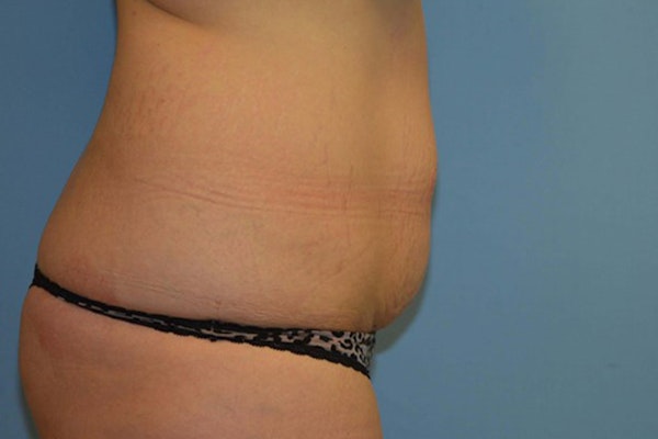 Tummy Tuck Before & After Gallery - Patient 249967 - Image 5