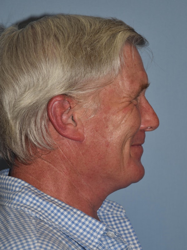 Facelift Before & After Gallery - Patient 123691 - Image 4