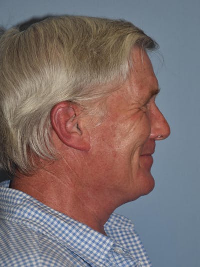 Facelift Before & After Gallery - Patient 123691 - Image 4