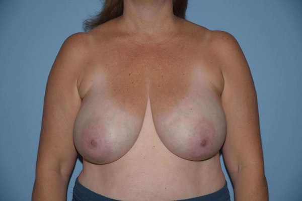 Before and After Long Island Breast Reduction