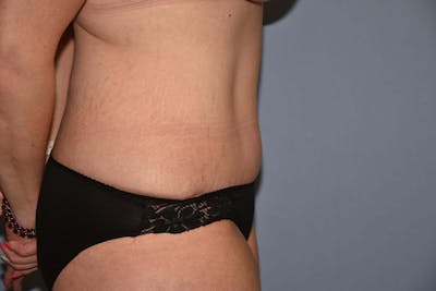 Tummy Tuck Before & After Gallery - Patient 249967 - Image 6