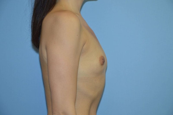 Breast Augmentation Before & After Gallery - Patient 301410 - Image 5