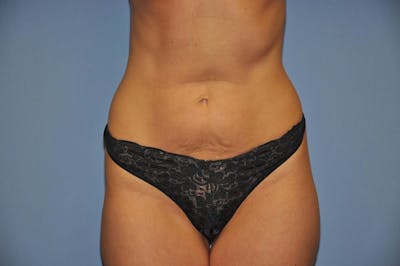 Tummy Tuck Before & After Gallery - Patient 391126 - Image 1