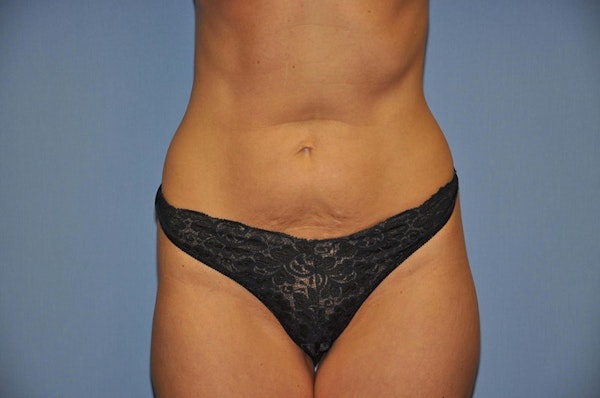 Tummy Tuck Before & After Gallery - Patient 391126 - Image 1