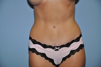 Tummy Tuck Before & After Gallery - Patient 391126 - Image 2