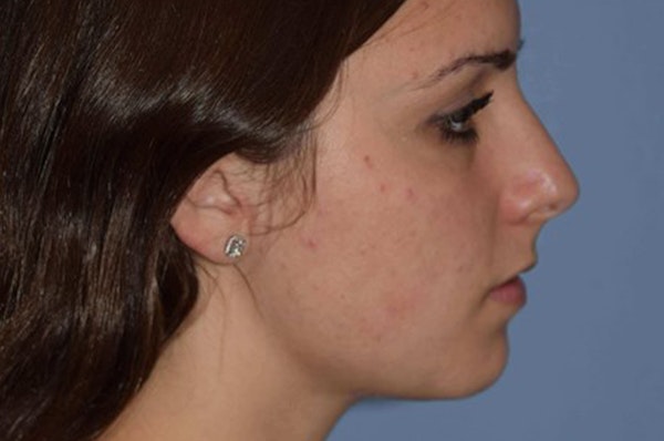 Rhinoplasty Before & After Gallery - Patient 177328 - Image 1