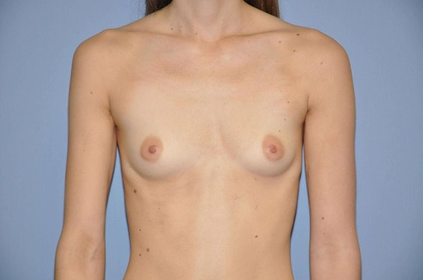 Breast Augmentation Before & After Gallery - Patient 186670 - Image 1