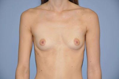 Breast Augmentation Before & After Gallery - Patient 186670 - Image 1