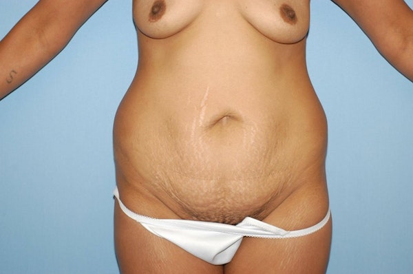 Tummy Tuck Before & After Gallery - Patient 336205 - Image 1
