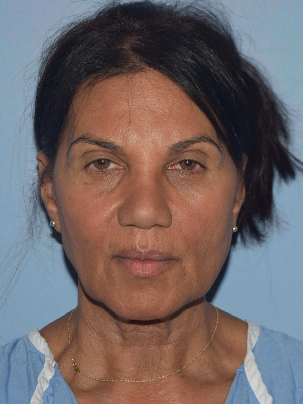 Facelift Before & After Gallery - Patient 105446 - Image 1