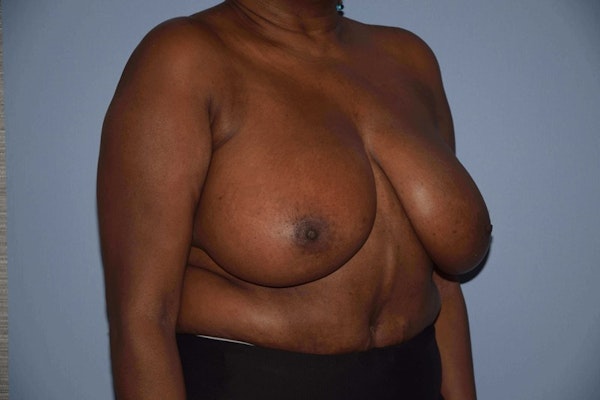 Breast Reduction Before & After Gallery - Patient 311912 - Image 3