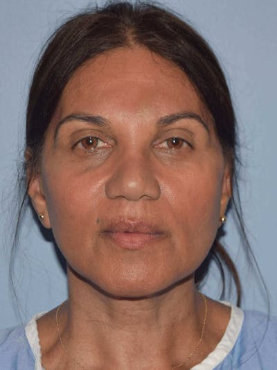Facelift Before & After Gallery - Patient 105446 - Image 2