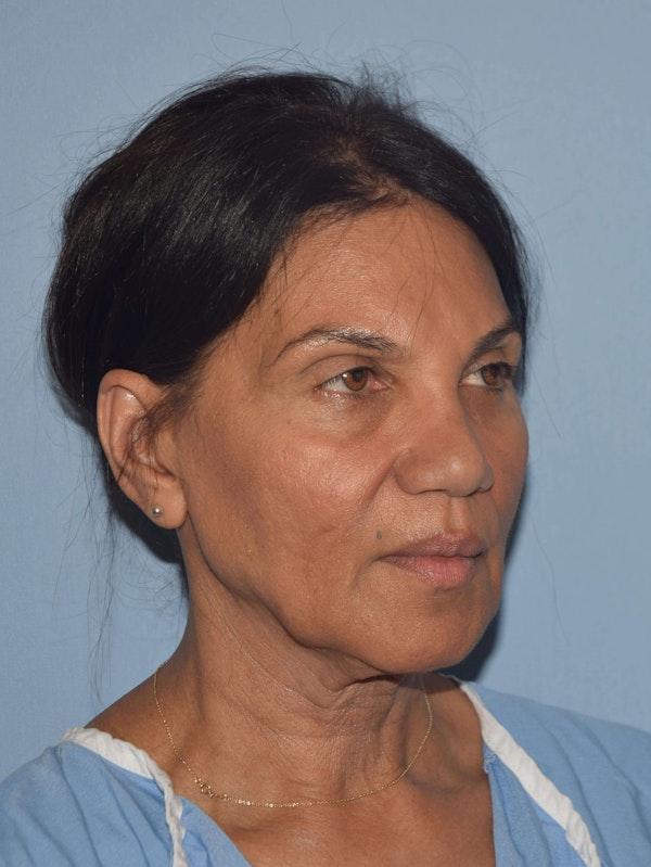 Facelift Before & After Gallery - Patient 105446 - Image 3