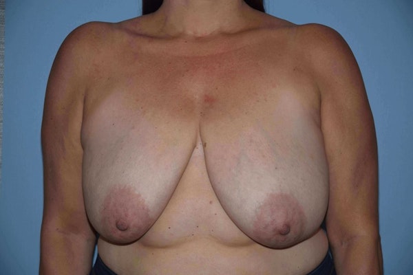 Breast Reduction Before & After Gallery - Patient 117355 - Image 1