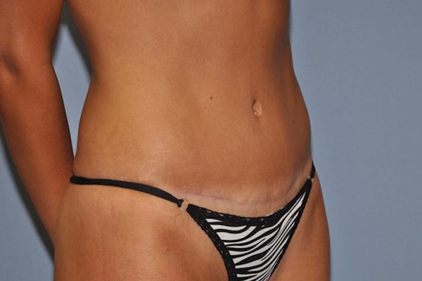 Tummy Tuck Before & After Gallery - Patient 363817 - Image 4