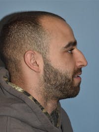 Rhinoplasty Before & After Gallery - Patient 282021 - Image 1