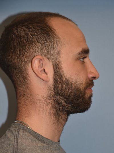 Rhinoplasty Before & After Gallery - Patient 282021 - Image 2