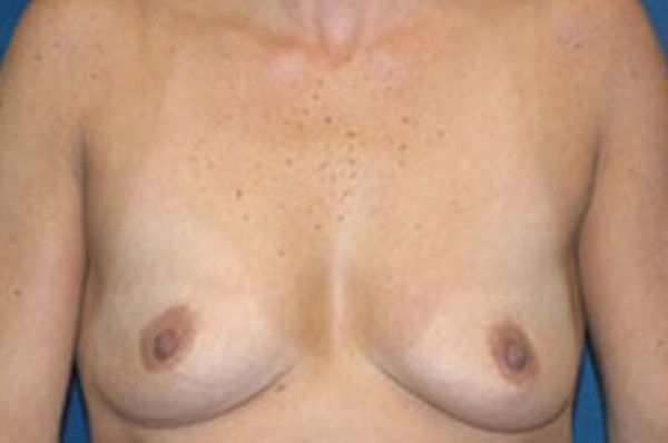 Breast Augmentation Before & After Gallery - Patient 191498 - Image 1