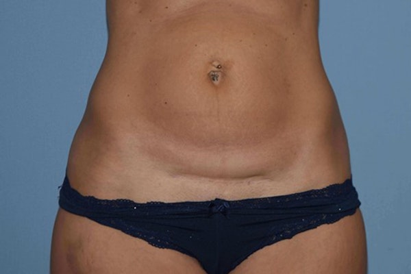 Tummy Tuck Before & After Gallery - Patient 222081 - Image 1