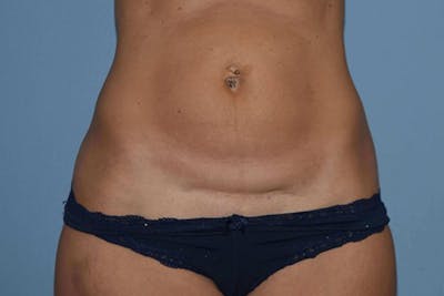 Tummy Tuck Before & After Gallery - Patient 222081 - Image 1