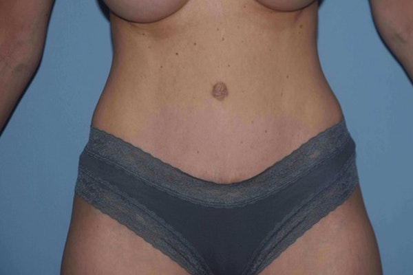 Tummy Tuck Before & After Gallery - Patient 222081 - Image 2