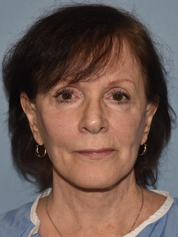 Facelift Before & After Gallery - Patient 423138 - Image 1
