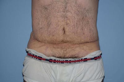 Tummy Tuck Before & After Gallery - Patient 412051 - Image 1