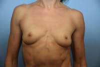 Breast Augmentation Before & After Gallery - Patient 249422 - Image 1