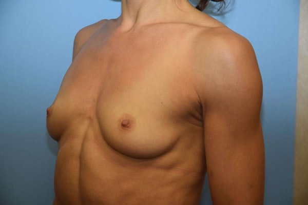 Breast Augmentation Before & After Gallery - Patient 249422 - Image 3