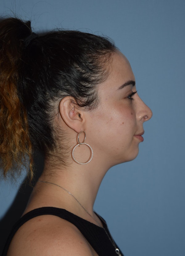 Rhinoplasty Before & After Gallery - Patient 195528 - Image 2