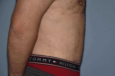 Tummy Tuck Before & After Gallery - Patient 412051 - Image 6