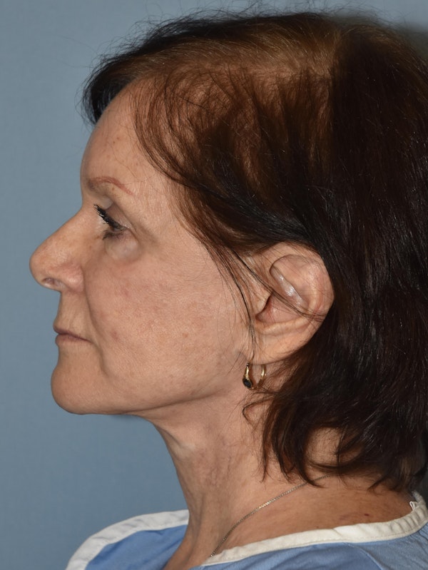 Facelift Before & After Gallery - Patient 423138 - Image 5