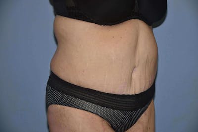 Tummy Tuck Before & After Gallery - Patient 884290 - Image 4