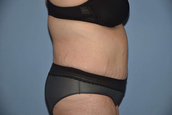 Tummy Tuck Before & After Gallery - Patient 884290 - Image 6