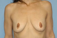 Breast Augmentation Before & After Gallery - Patient 293830 - Image 1