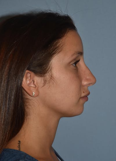 Rhinoplasty Before & After Gallery - Patient 143678 - Image 1