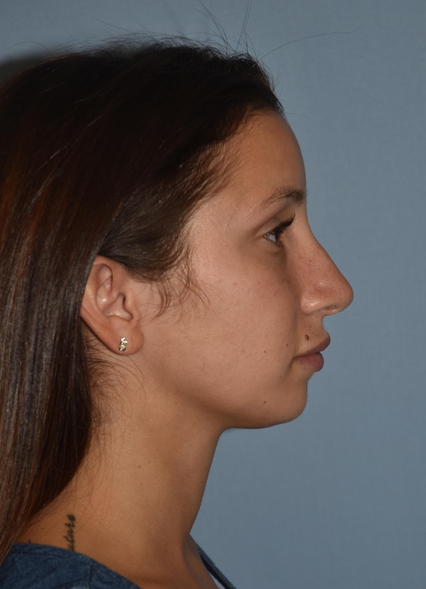 Rhinoplasty Before & After Gallery - Patient 143678 - Image 1