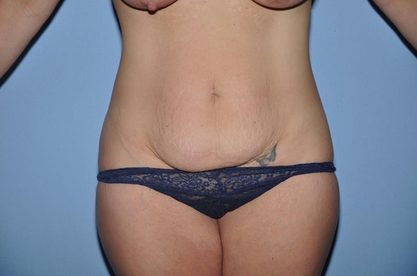 Before and After Abdominoplasty in Long Island