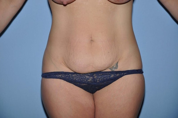 Tummy Tuck Before & After Gallery - Patient 358445 - Image 1