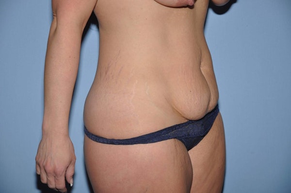 Tummy Tuck Before & After Gallery - Patient 358445 - Image 3