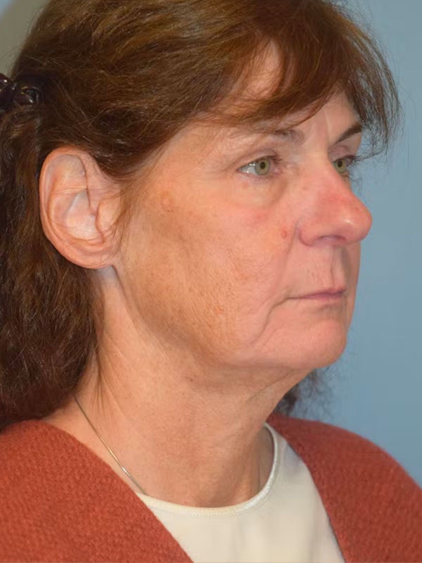 Facelift Before & After Gallery - Patient 289228 - Image 3