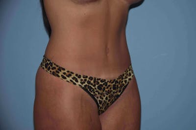 Tummy Tuck Before & After Gallery - Patient 358445 - Image 4