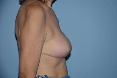 Breast Reduction Before & After Gallery - Patient 207434 - Image 6