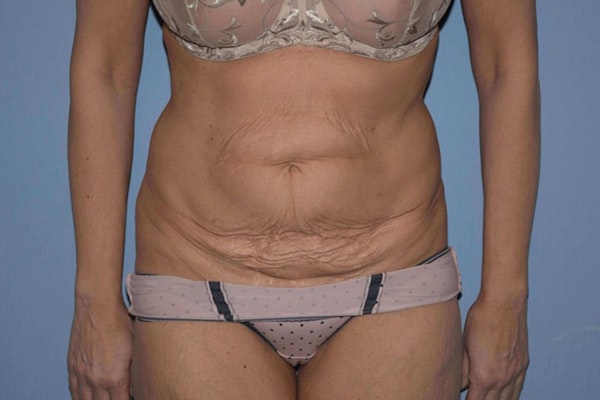 Tummy Tuck Before & After Gallery - Patient 300630 - Image 1