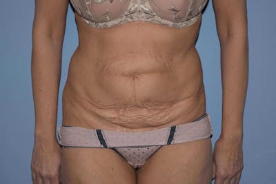 Tummy Tuck Before & After Gallery - Patient 300630 - Image 1