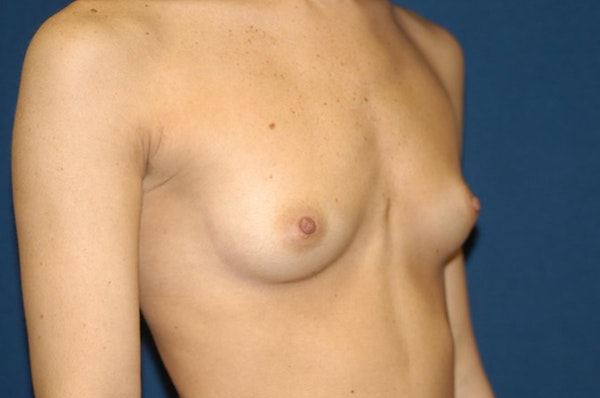 Breast Augmentation Before & After Gallery - Patient 403282 - Image 3