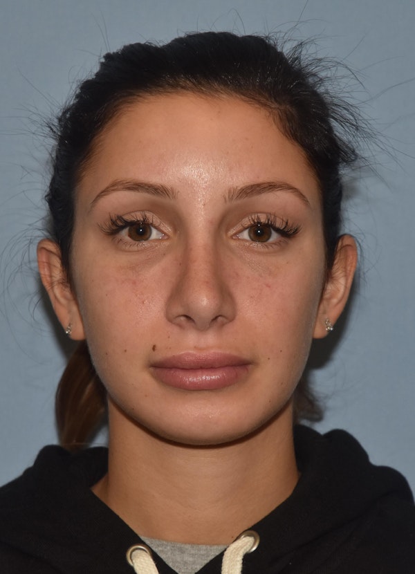 Rhinoplasty Before & After Gallery - Patient 143678 - Image 4