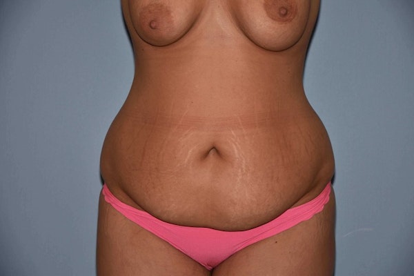 Tummy Tuck Before & After Gallery - Patient 204149 - Image 1
